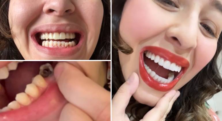 Com novo sorriso, Camila Monteiro revela ter perdido dentes por conta da depressão: ‘Sentia vergonha’