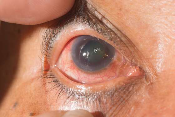 ENTENDA:   Glaucoma é a maior causa de cegueira irreversível no mundo