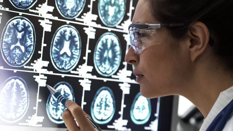 Cientistas podem ter desvendado enigma de como Alzheimer ‘mata’ neurônios