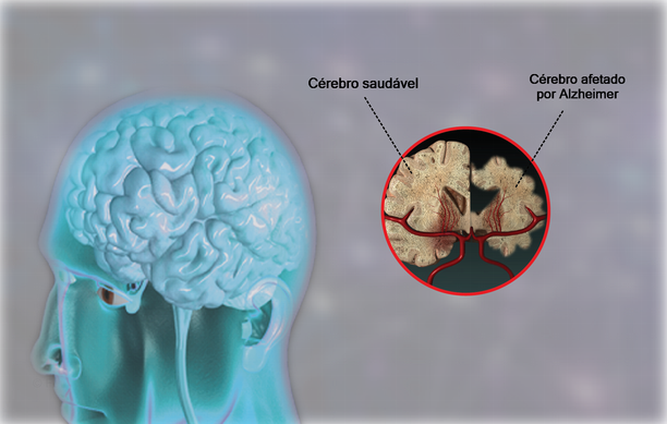 Doença de Alzheimer