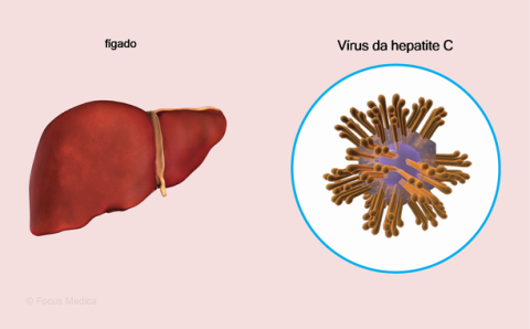 Uma infecção viral que causa a inflamação do fígado.