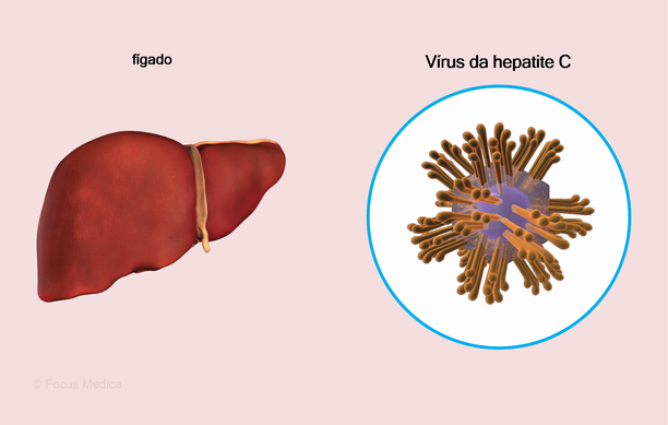 Uma infecção viral que causa a inflamação do fígado.