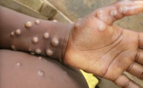 PARA EVITAR EPIDEMIA:  OMS estima custo de US$ 135 milhões em seis meses para conter mpox