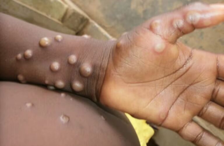 PARA EVITAR EPIDEMIA:  OMS estima custo de US$ 135 milhões em seis meses para conter mpox