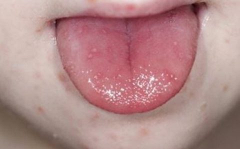 Doença altamente contagiosa afeta várias partes do corpo ao mesmo tempo