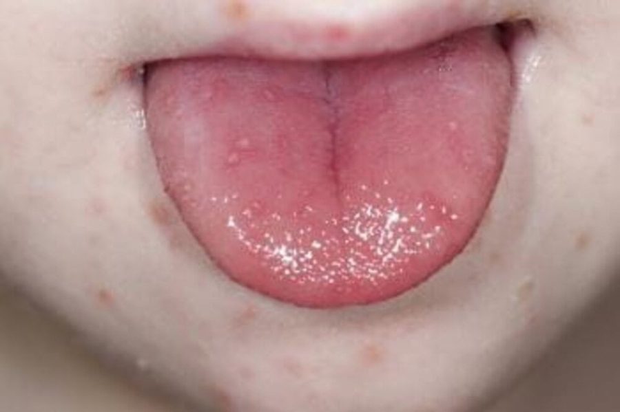 Doença altamente contagiosa afeta várias partes do corpo ao mesmo tempo