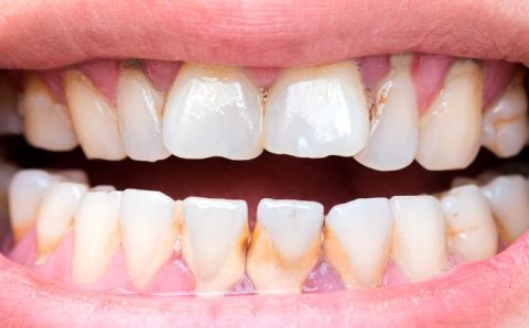 Tártaro nunca mais? Dentista revela receita caseira e fácil que viralizou na internet