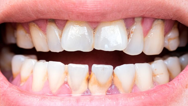 Tártaro nunca mais? Dentista revela receita caseira e fácil que viralizou na internet